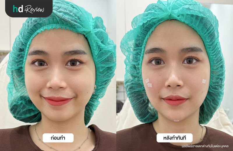 ผลลัพธ์หลังฉีดฟิลเลอร์คางและใต้ตา ที่ Le Lys Clinic