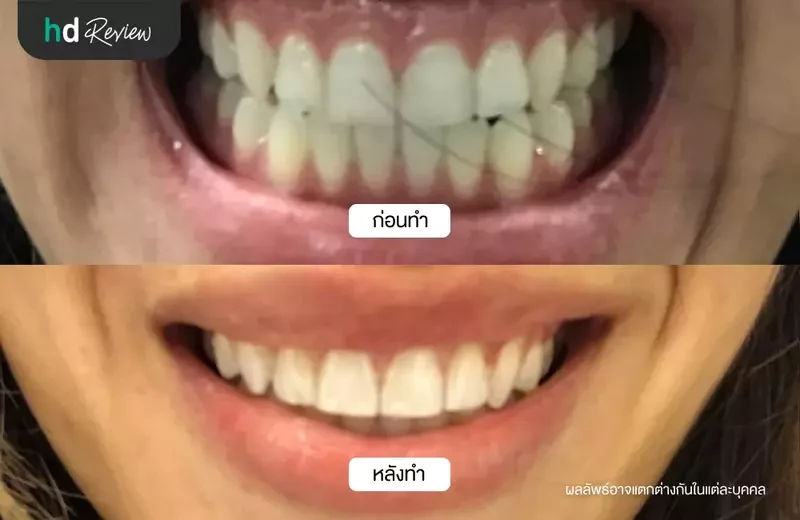 ภาพเปรียบเทียบก่อนและหลังตัดแต่งเหงือก ที่ Deezy Dental Home