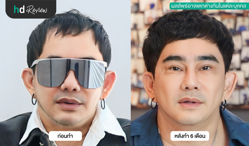 ภาพเปรียบเทียบผลลัพธ์ก่อนและหลังปลูกผม 6 เดือน