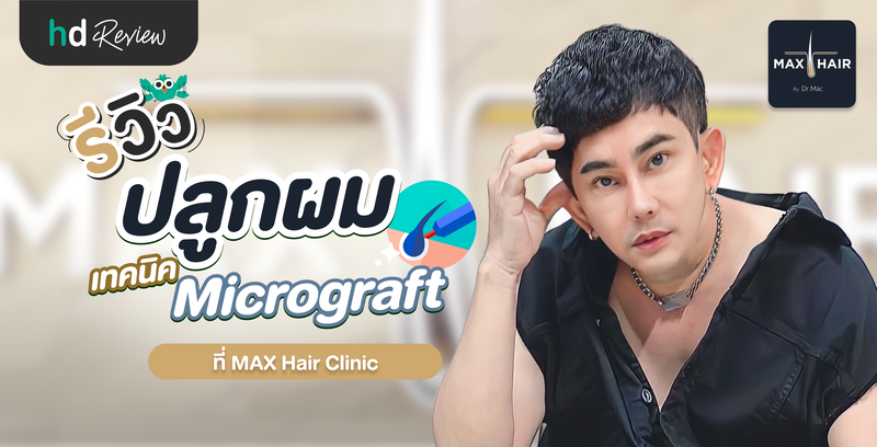 รีวิวปลูกผม ด้วยเทคนิค Micrograft ที่ Max Hair Clinic โดยคุณพชร์ อานนท์