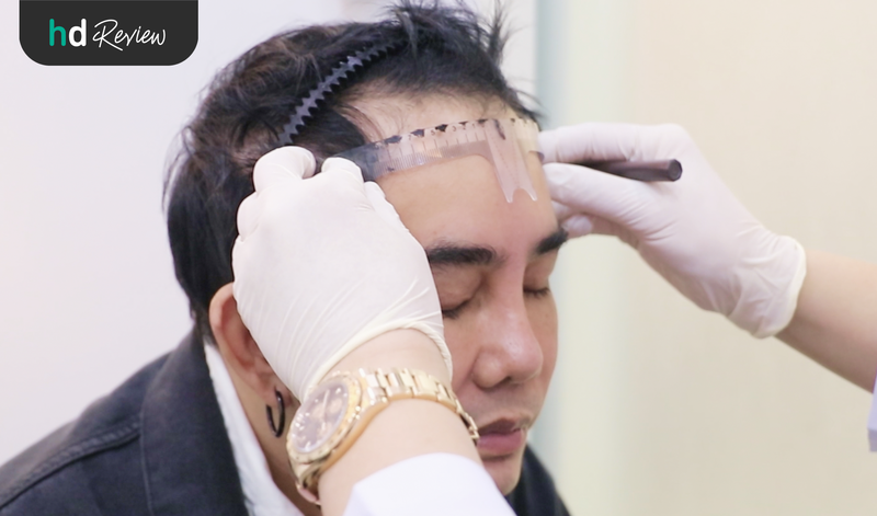 ขั้นตอนการตรวจประเมินก่อนปลูกผม