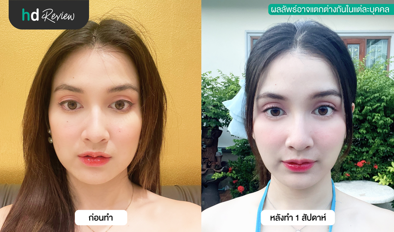 ผลลัพธ์หลังทำ HIFU
