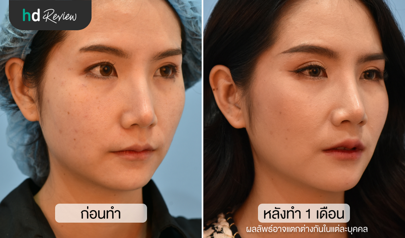 content review hifu ultracelq at aesthe clinic by chananschida jittrong 10
