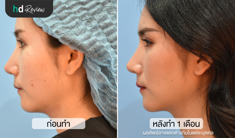 content review hifu ultracelq at aesthe clinic by chananschida jittrong 11