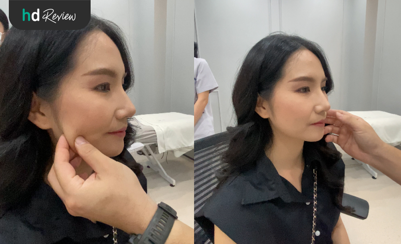 content review hifu ultracelq at aesthe clinic by chananschida jittrong 6