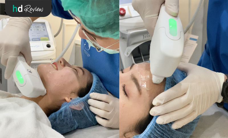 content review hifu ultracelq at aesthe clinic by chananschida jittrong 8