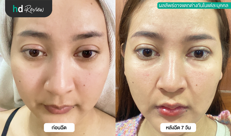 ผลลัพธ์หลังฉีดฟิลเลอร์ใต้ตา
