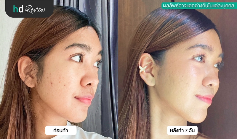 ผลลัพธ์หลังฉีด Skin Booster