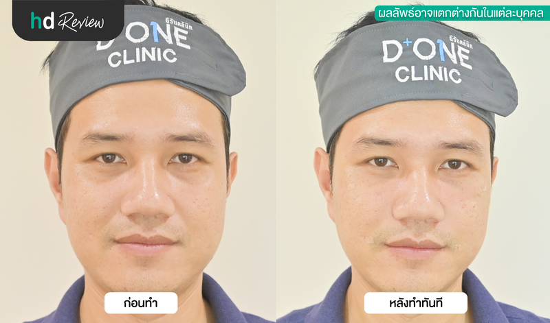 ผลลัพธ์หลังฉีดฟิลเลอร์ใต้ตา