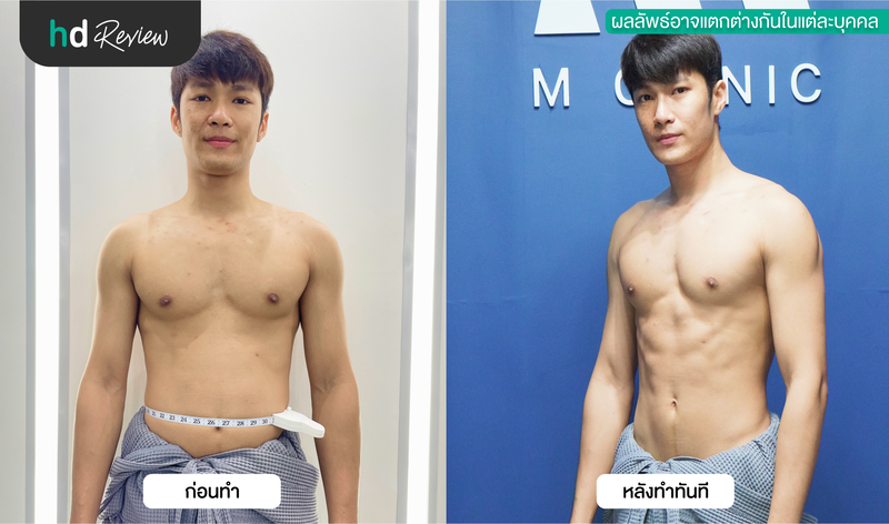 ผลลัพธ์หลังฉีดสลายไขมันบริเวณหน้าท้อง โปรแกรม M Fat Bomb