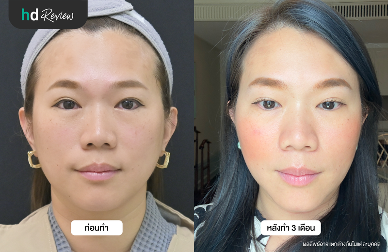 ผลลัพธ์หลังทำ 3 เดือน