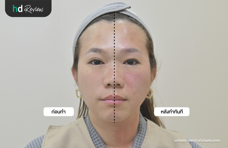 ภาพเปรียบเทียบผลลัพธ์ก่อนทำ Morpheus 8 และหลังทำทันที