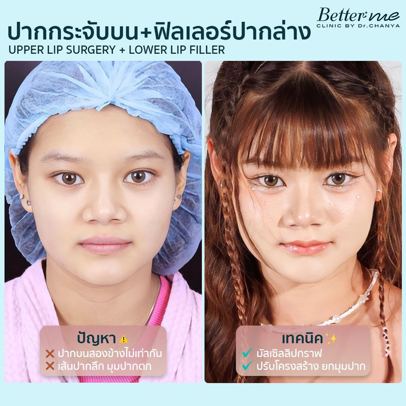 ผลลัพธ์หลังทำปากกระจับ คุณมินนี่