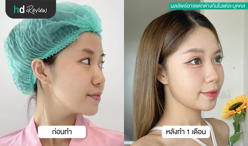 ดูดไขมันเหนียง รีวิว