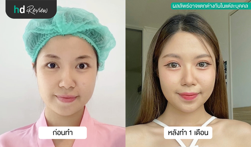 ผลลัพธ์หลังดูดไขมันเหนียง