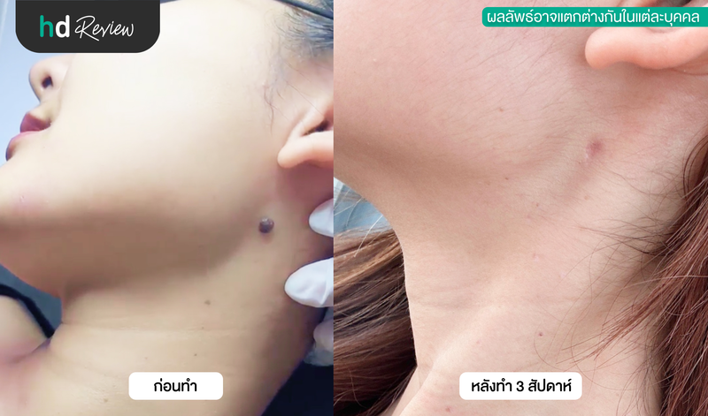ผลลัพธ์หลังจี้ไฝ ด้วยเลเซอร์ CO2 ที่ Cottonwool Clinic