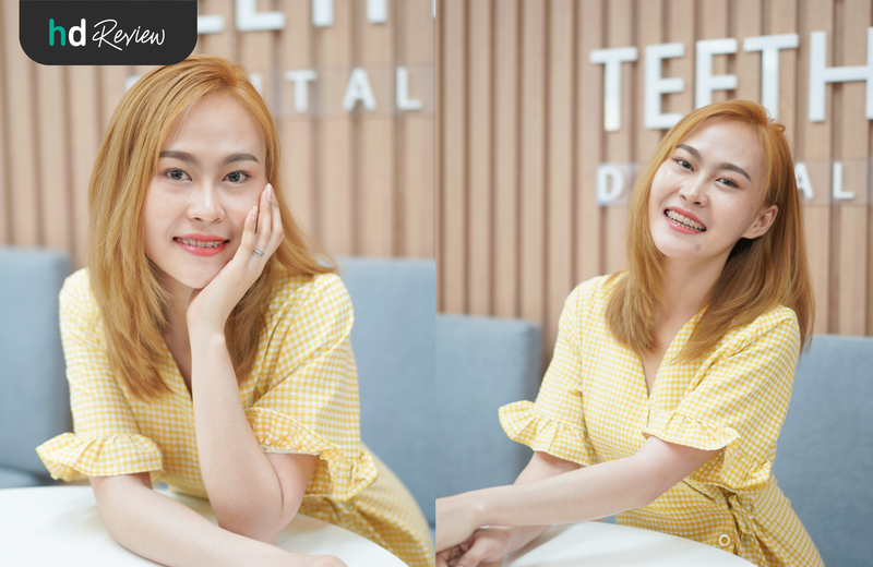 ผู้ใช้บริการจัดฟันโลหะ รอบ 2 แก้ปัญหาฟันล่างคร่อมฟันบน ที่ Teeth Talk Dental Clinic
