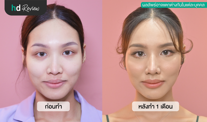 ภาพเปรียบเทียบผลลัพธ์ก่อนและหลังทำ 1 เดือน