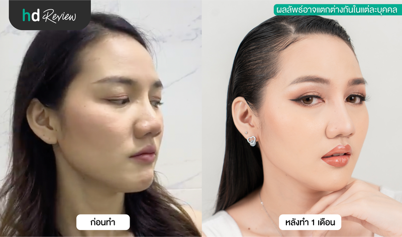 ผลลัพธ์หลังแก้จมูก เทคนิค Semi-Open ที่ M Med Clinic International