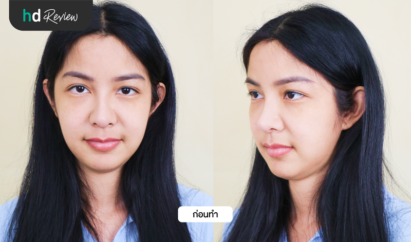 ภาพก่อนแก้จมูก ฟิล์ม ทิฟฟานี