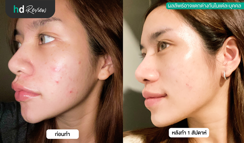 ผลลัพธ์หลังทำ Pico Laser ครบ 1 สัปดาห์