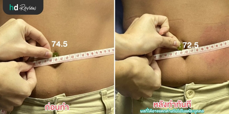 รีวิวสลายไขมันด้วยความเย็น Cool Slim ที่ Punnisa Clinic