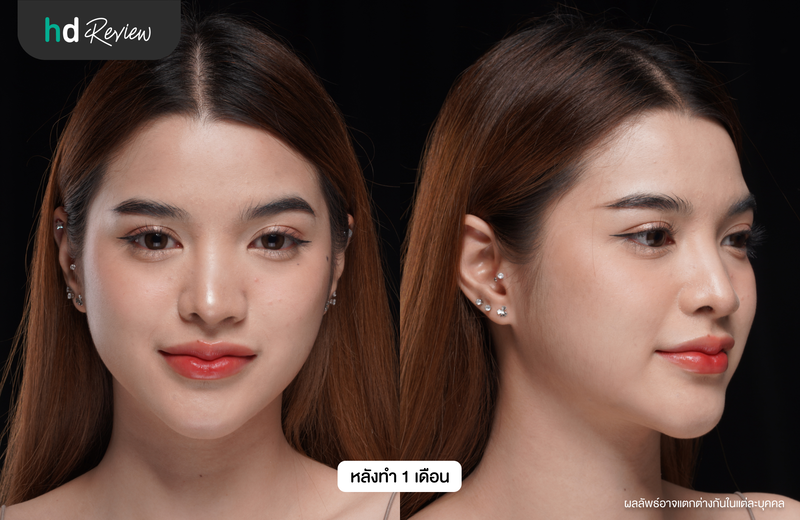 ผลลัพธ์หลังเสริมคางครบ 1 เดือน