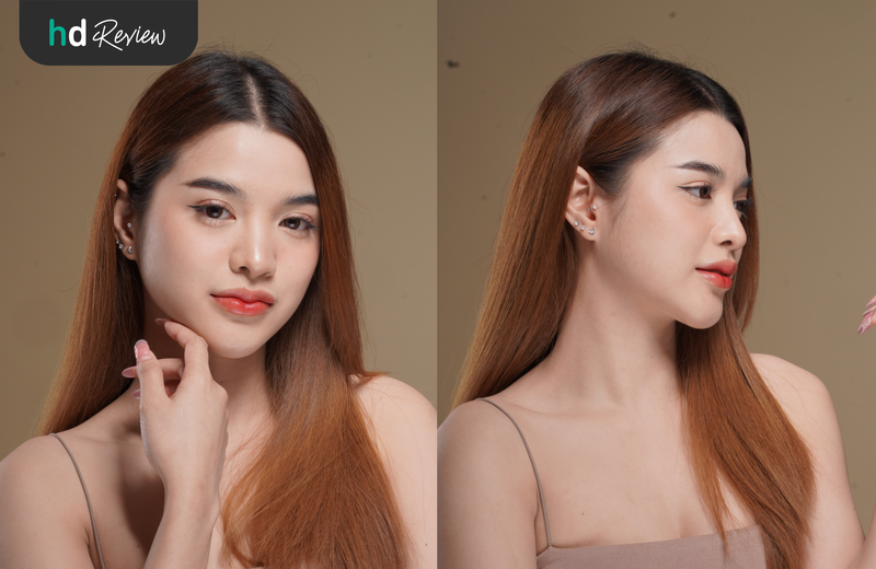 เสริมคาง เทคนิค Ultra Lock ที่ Sowon Clinic