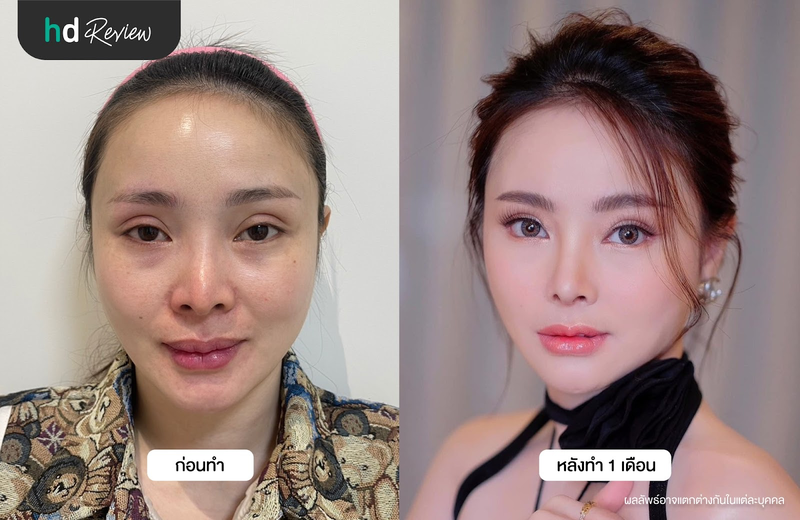 ก่อนและหลังแก้จมูก ที่ รพ. ไอดี