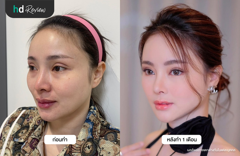ก่อนและหลังแก้จมูก 2 ที่ รพ. ไอดี