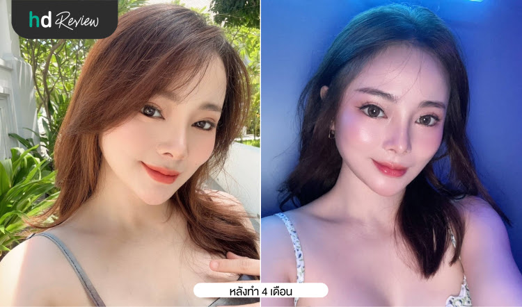 หลังแก้จมูก ที่ รพ. ไอดี