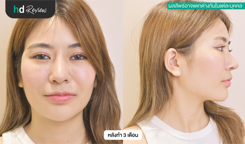 ผลลัพธ์หลังเสริมจมูก เทคนิค Open ที่ MediPrime Clinic