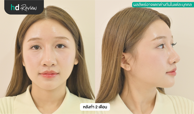 ผลลัพธ์หลังเสริมจมูก เปรียบเทียบ