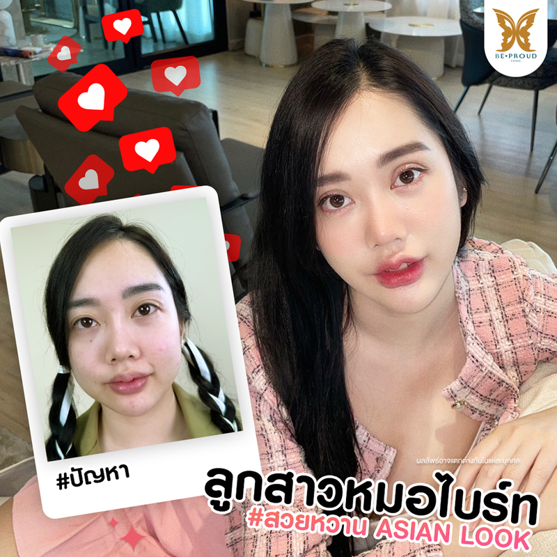 ทำตาสองชั้น เทคนิคกรีดตายาวแผลมินิ ที่ Beproud Clinic รูป 3