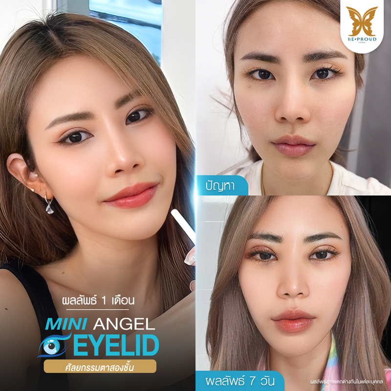 ทำตาสองชั้น เทคนิคกรีดตายาวแผลมินิ ที่ Beproud Clinic รูป 7