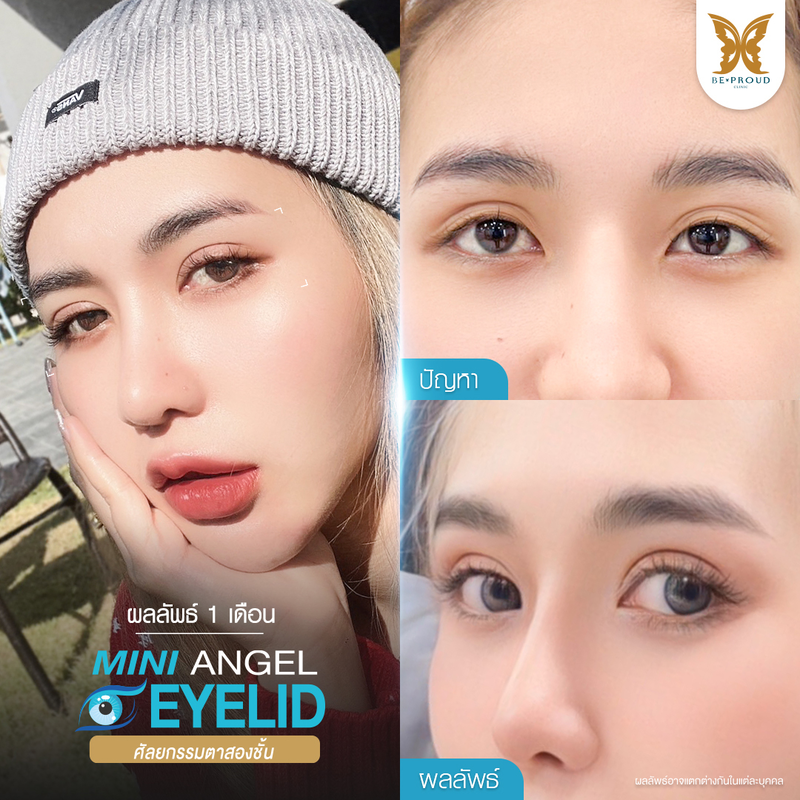 ทำตาสองชั้น เทคนิคกรีดตายาวแผลมินิ ที่ Beproud Clinic รูป 5