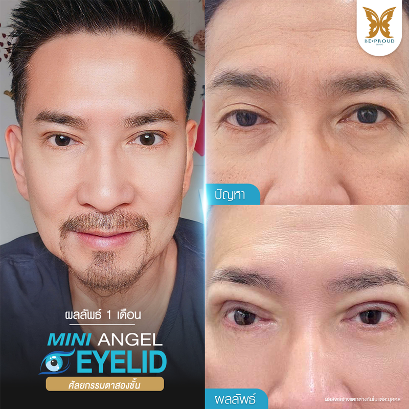 ทำตาสองชั้น เทคนิคกรีดตายาวแผลมินิ ที่ Beproud Clinic รูป 4