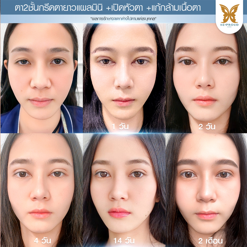 ทำตาสองชั้น เทคนิคกรีดตายาวแผลมินิ ที่ Beproud Clinic รูป 9