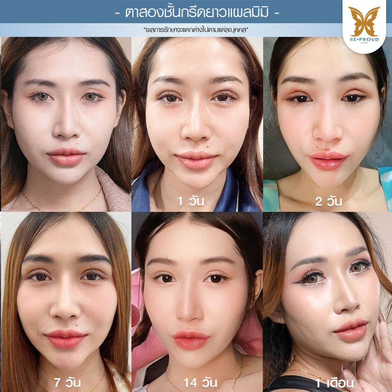 ทำตาสองชั้น เทคนิคกรีดตายาวแผลมินิ ที่ Beproud Clinic รูป 8