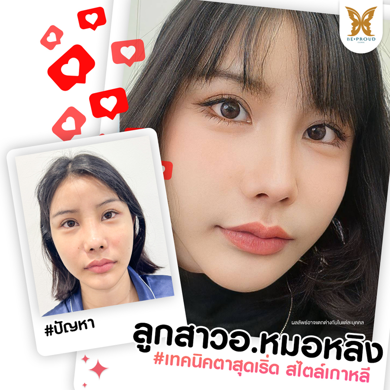 ทำตาสองชั้น เทคนิคกรีดตายาวแผลมินิ ที่ Beproud Clinic รูป 1
