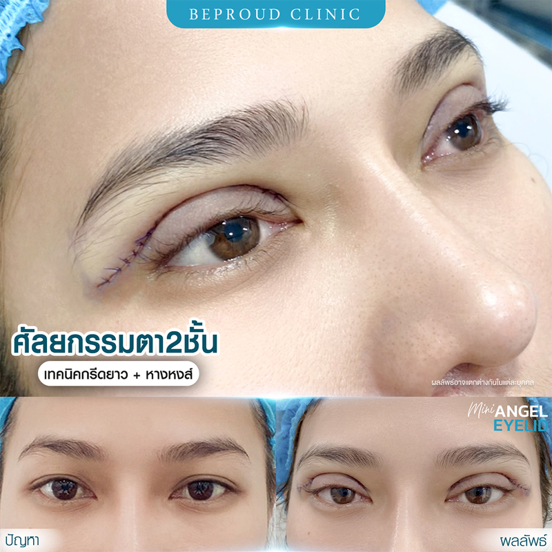 ทำตาสองชั้น เทคนิคกรีดตายาวแผลมินิ ที่ Beproud Clinic รูป 14