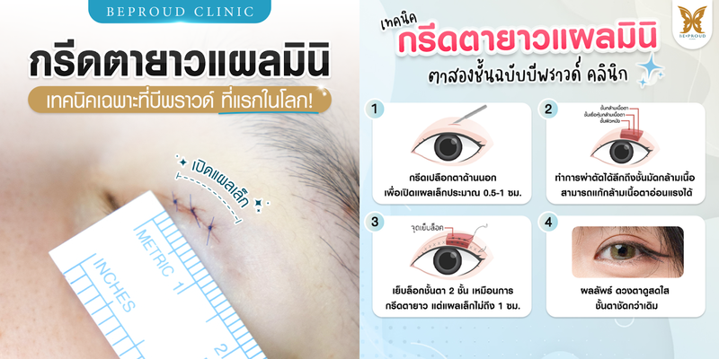 ทำตาสองชั้น เทคนิคกรีดตายาวแผลมินิ