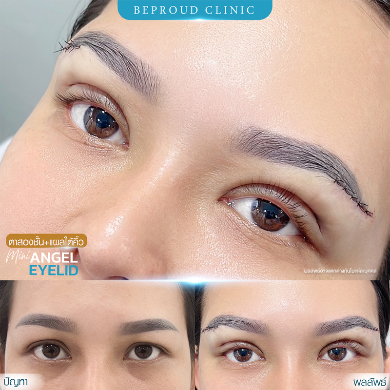 ทำตาสองชั้น เทคนิคกรีดตายาวแผลมินิ ที่ Beproud Clinic รูป 15