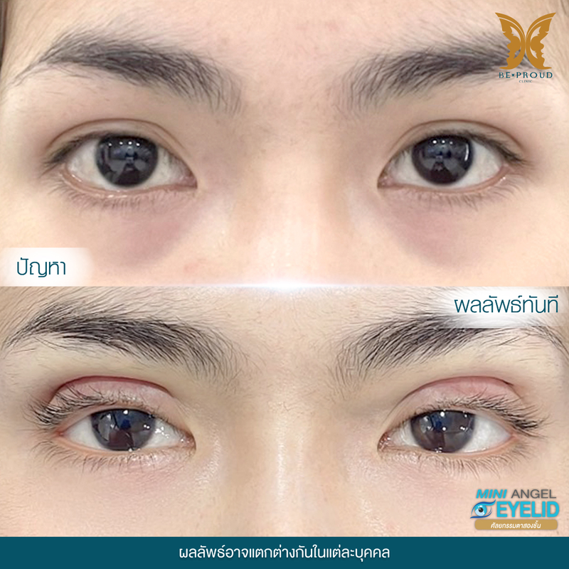 ทำตาสองชั้น เทคนิคกรีดตายาวแผลมินิ ที่ Beproud Clinic รูป 10