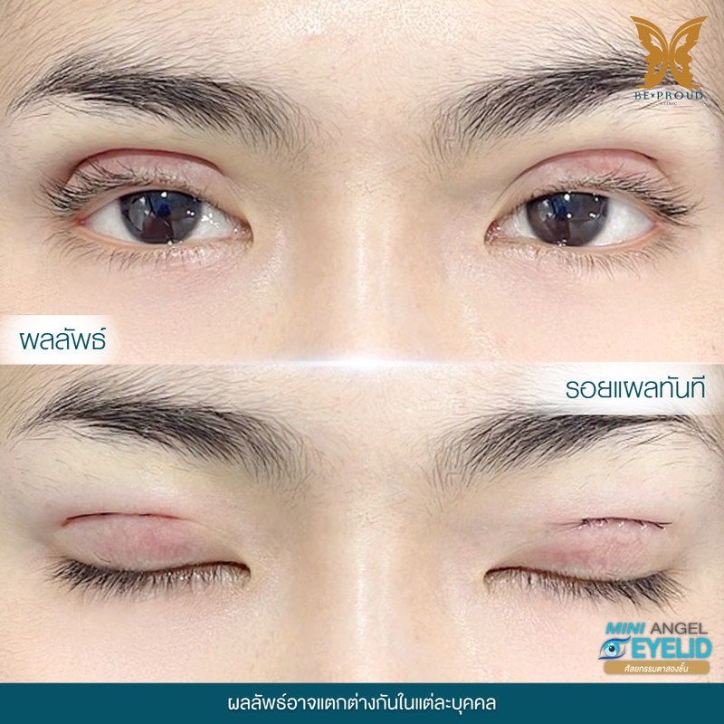 ทำตาสองชั้น เทคนิคกรีดตายาวแผลมินิ ที่ Beproud Clinic รูป 11