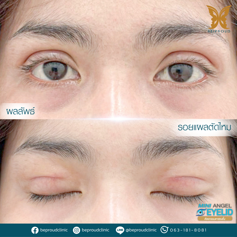 ทำตาสองชั้น เทคนิคกรีดตายาวแผลมินิ ที่ Beproud Clinic รูป 12