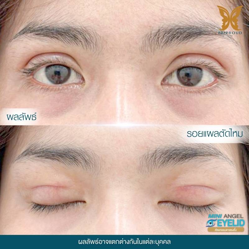 ทำตาสองชั้น เทคนิคกรีดตายาวแผลมินิ ที่ Beproud Clinic รูป 13