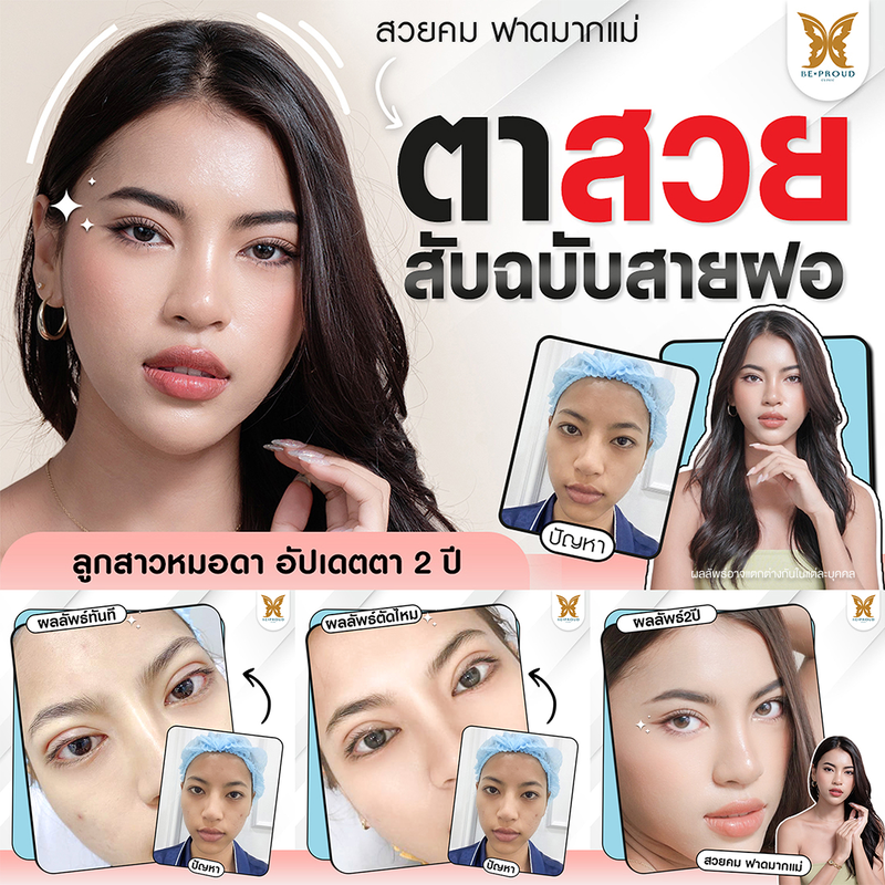 ทำตาสองชั้น เทคนิคกรีดตายาวแผลมินิ ที่ Beproud Clinic รูป 17