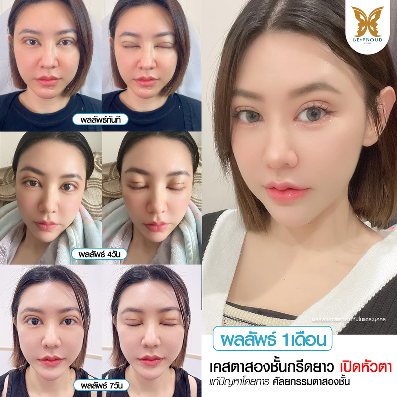 ทำตาสองชั้น เทคนิคกรีดตายาวแผลมินิ ที่ Beproud Clinic รูป 16