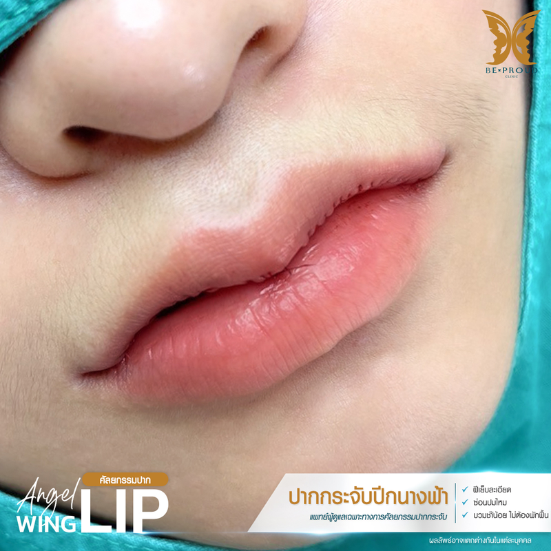 ผลลัพธ์หลังทำทำปากกระจับปีกนางฟ้า ที่ Beproud Clinic รูป 10